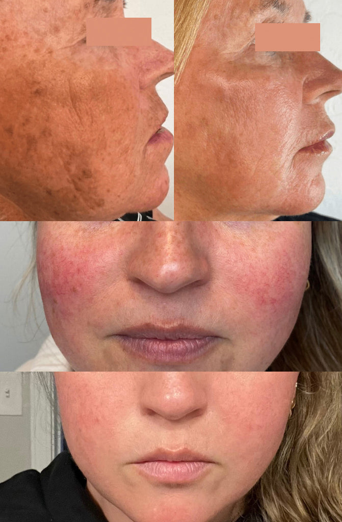 IPL Photofacial Before and After for Age Spots, Sun Spots, and Rosacea on the Cheeks
