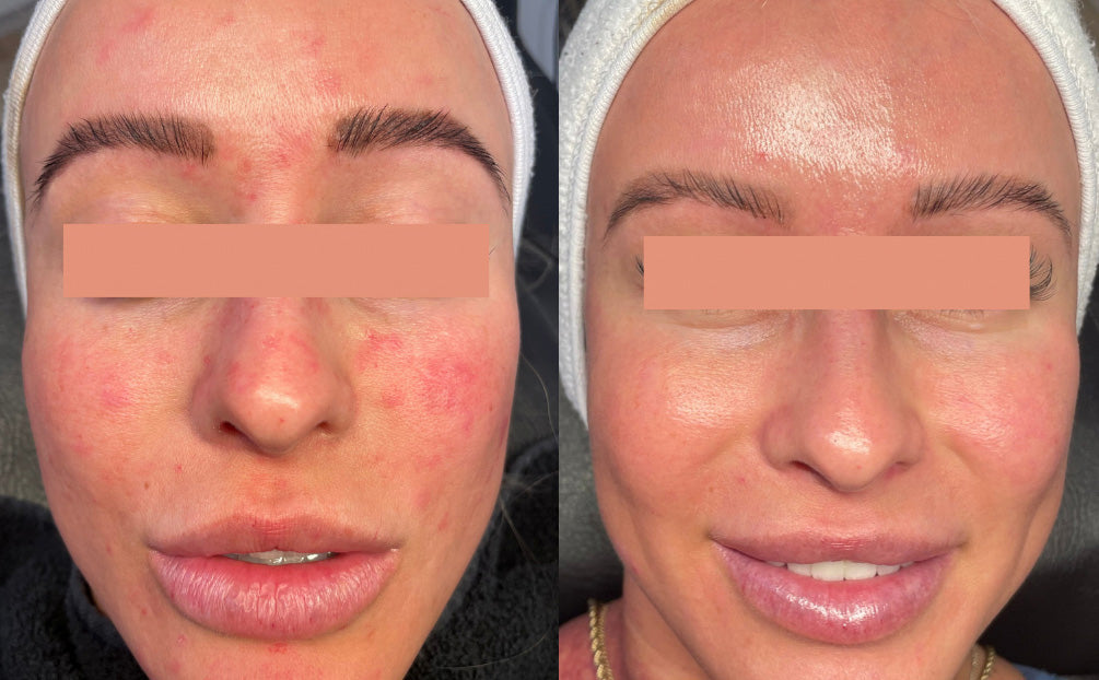 IPL Photofacial Before and After of Red Spots on Face