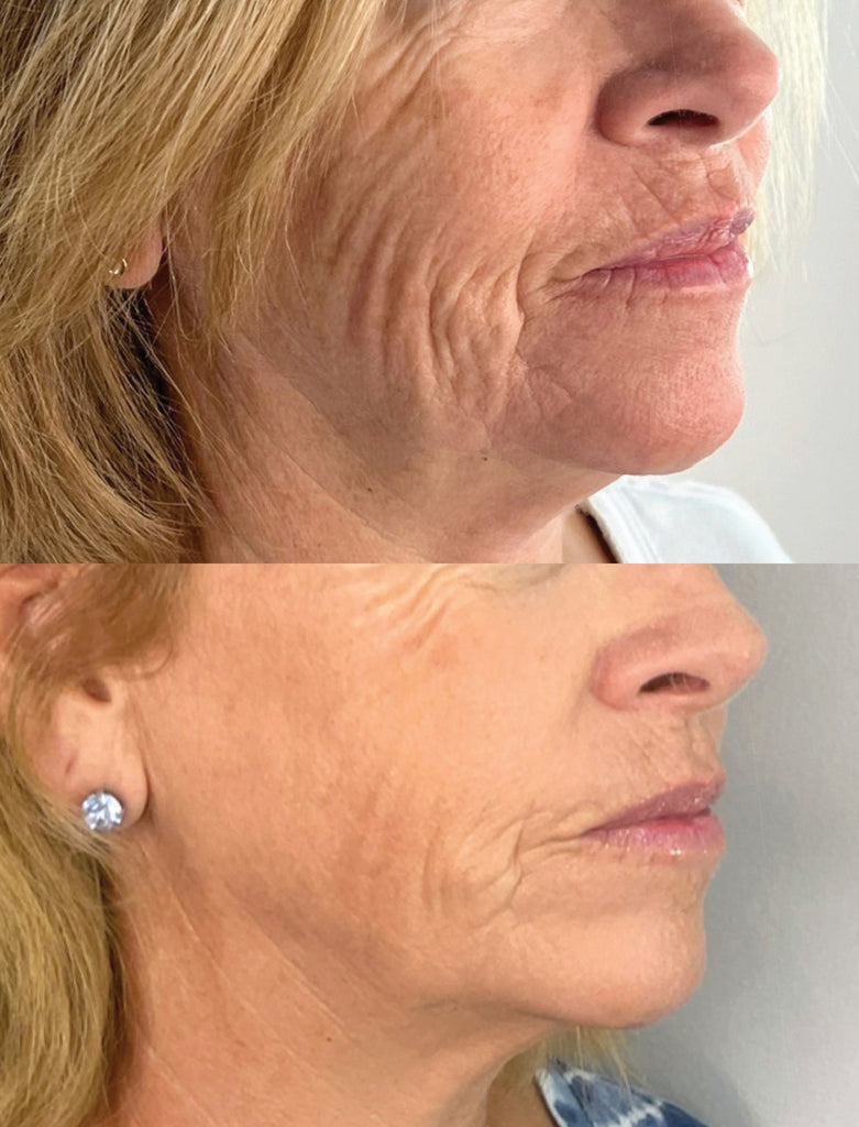 RF Microneedling Treatment Before and After To Wrinkles and Fine Lines on The Face and Neck