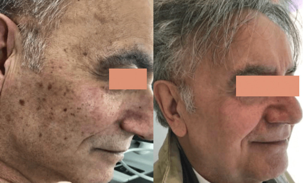 IPL Photofacial Before and After of Age Spots