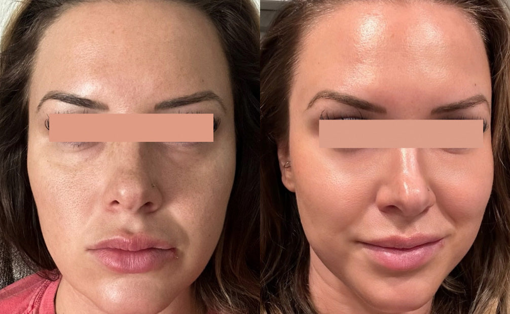 IPL Photofacial Before and After of Face