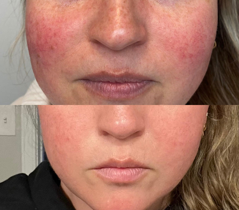IPL Photofacial Before and After of Rosacea on Cheeks