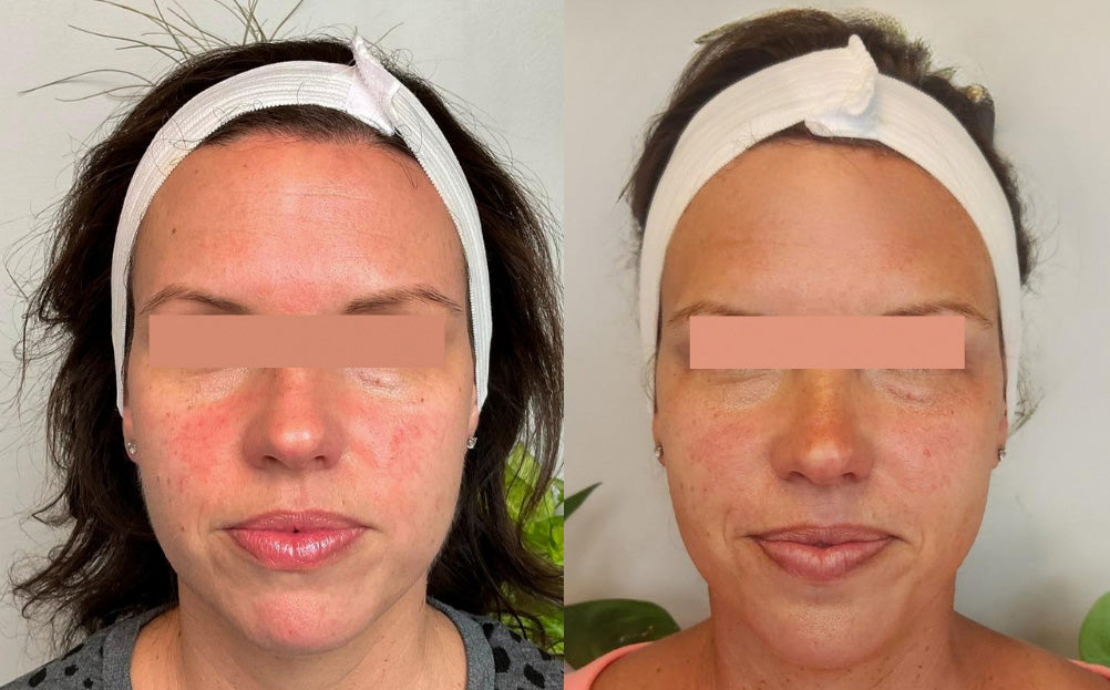 IPL Photofacial Before and After of Rosacea