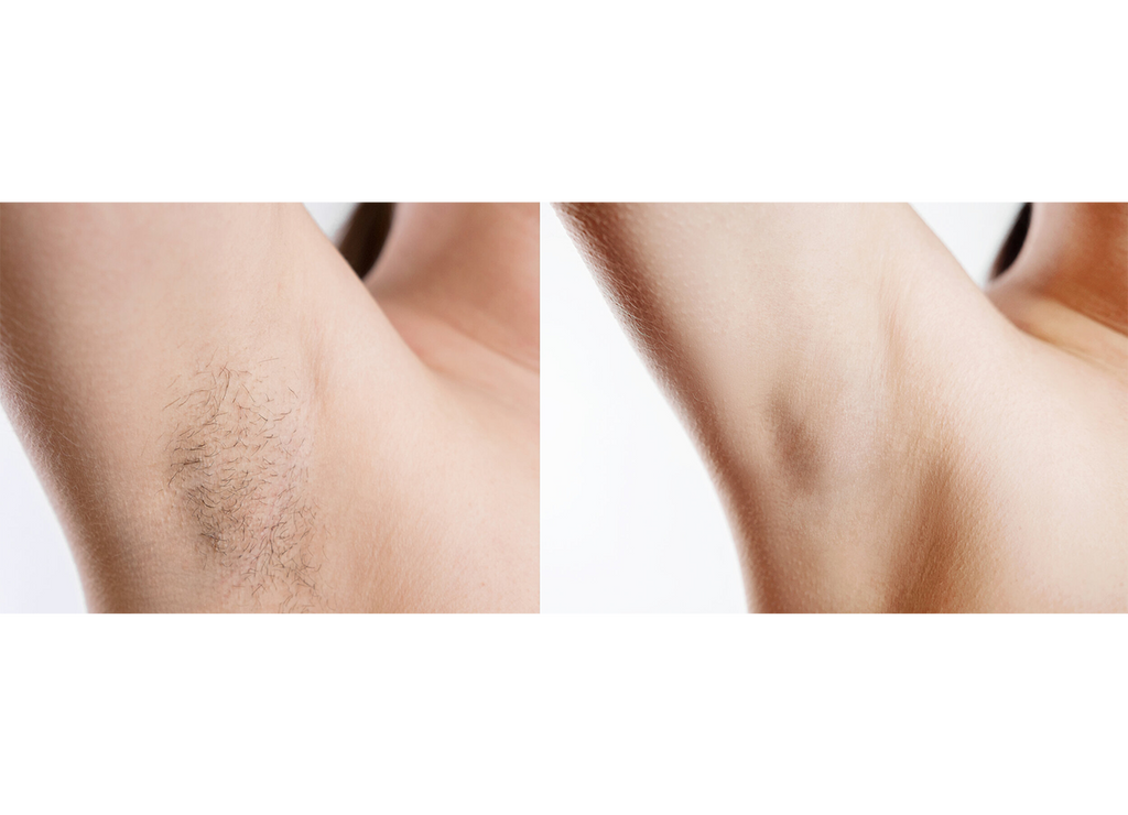 Before and after of Pain Free Laser Hair Removal on the underarms