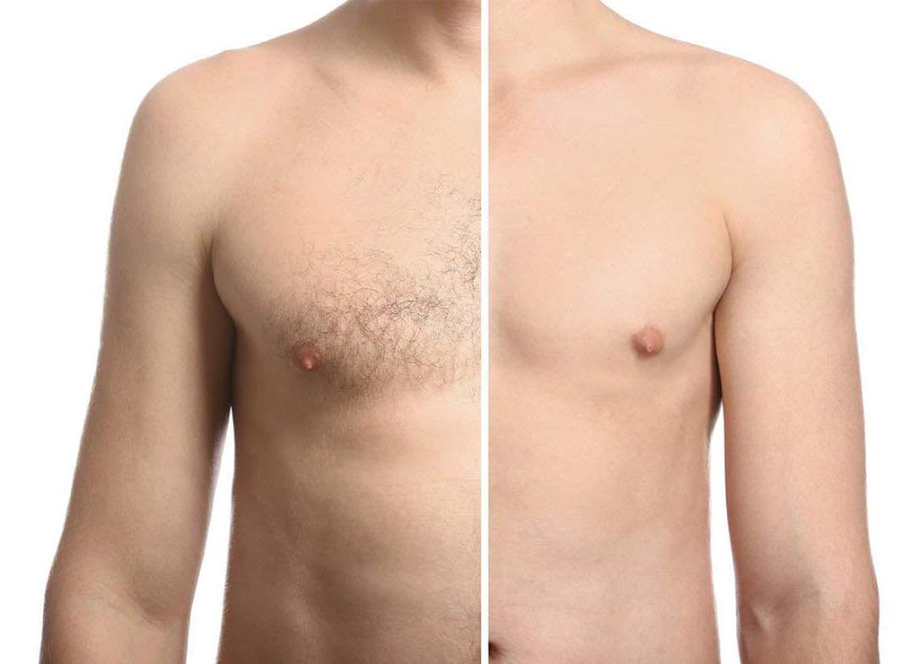 Before and after of Pain Free Laser Hair Removal on the chest
