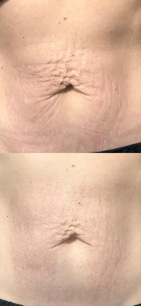 RF Microneedling Treatment Before and After To Stretch Marks and Loose Skin on the Stomach