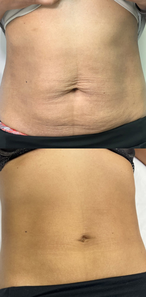 RF Microneedling Treatment Before and After To Loose Skin and Stretch Marks on the Stomach
