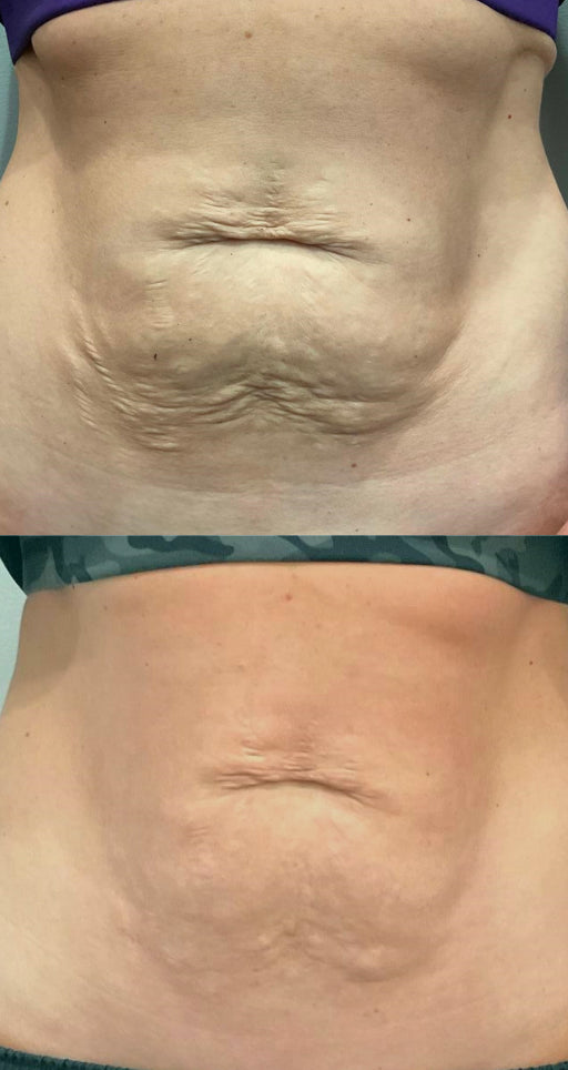 RF Microneedling Treatment Before and After To Stretch Marks and Loose Skin To Stomach