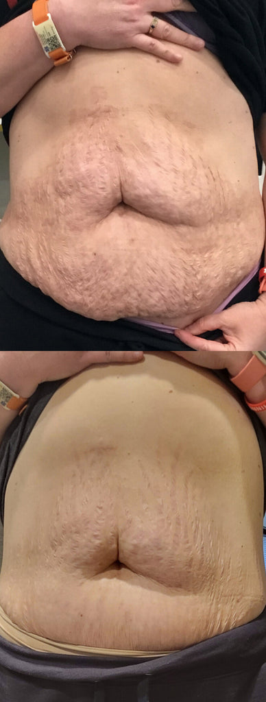 RF Microneedling Treatment Before and After To Stretch Marks on the Stomach