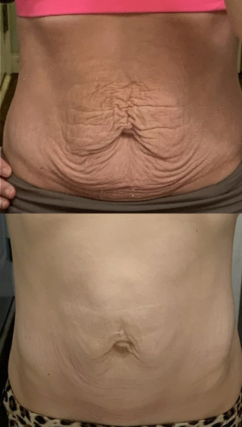RF Microneedling Treatment Before and After To Stretch Marks and Loose Skin on Stomach