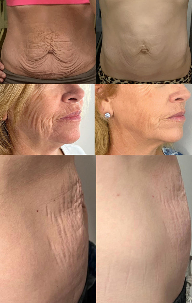 Before and After Photos of RF Microneedling Treatment on Stretch Marks, Loose Skin, and Wrinkles and Fine Lines
